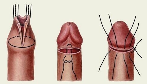 the essence of penis enlargement surgery