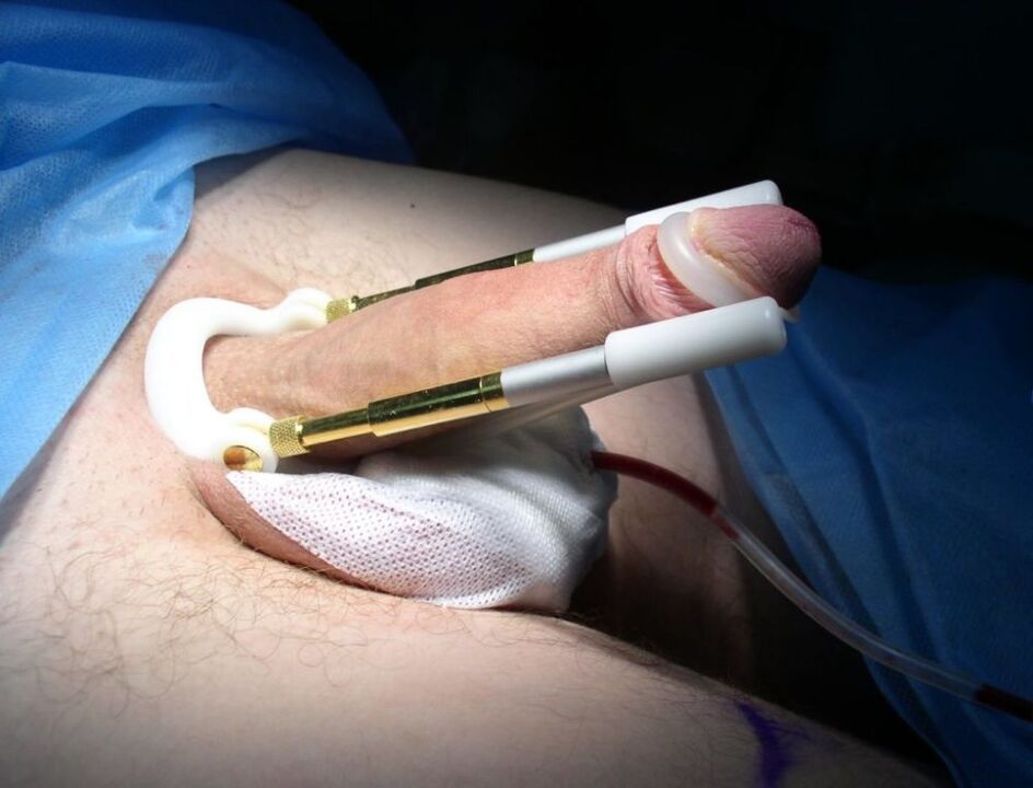 Extension after penis enlargement surgery