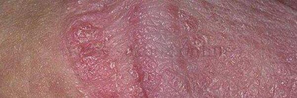 Dry skin and ulcers on the penis head after using baking soda